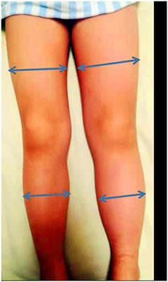 Case Report: Rare Iliac Vein Compression (May–Thurner) Syndrome in a Pediatric Patient